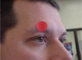 <p>Which frontal bone marking is this? (2)</p>