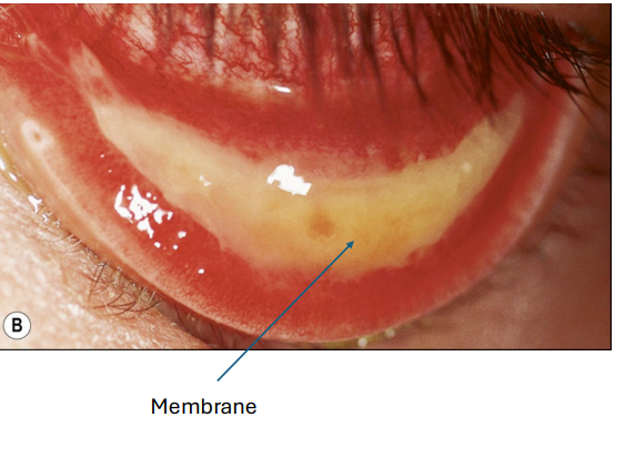 <p></p><p><strong><u>• Mucopurulent discharge</u></strong></p><p><strong><u>• Conjunctival papillae</u></strong></p><p>• Conjunctival hyperemia •</p><p>Chemosis</p><p>• Foreign body sensation</p><p>• Lid Edema</p><p>• <strong><u>Membranes</u></strong></p>