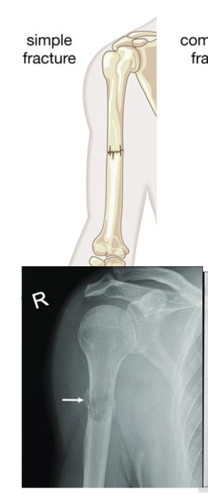 <p>Fx where bone does not break through the skin</p>