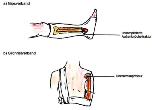 <ul><li><p>konservative</p><ul><li><p>Extension</p></li><li><p>geschlossene Reposition</p></li><li><p>Gips-/Kunststoffverbände</p></li><li><p>Fixierende Ruhigstellung bis zur Knochenheilung</p></li><li><p>z.T. Ruhigstellung angrenzender Gelenke</p></li></ul></li><li><p>operative</p><ul><li><p>bessere anatomische Reposition</p></li></ul></li></ul><p></p>