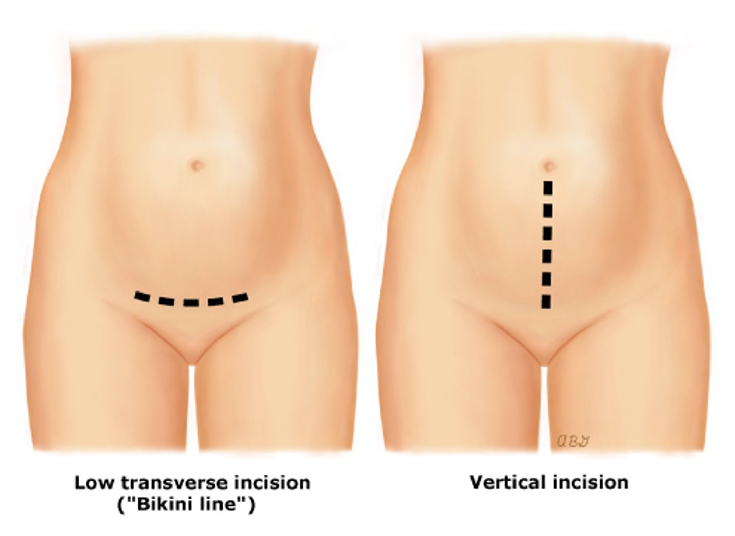<p>Hysterectomy approaches:</p><p>- indications: large tumors, tube + ovary removal,exploring pelvic cavity/complex cases (need greater access + visualization)</p><p>- most invasive (last choice)</p><p>- large abdo incision </p><p>- bikini cut/horizontal or vertical (larger + longer healing)</p>