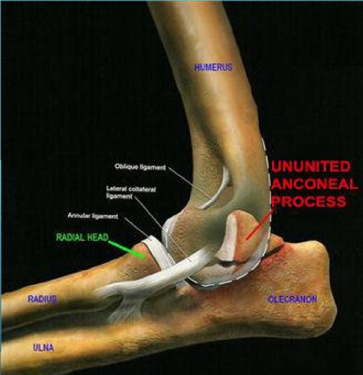 <p><strong>Ununited anconeal process (UAP)</strong></p><ul><li><p><span>characterized by a failure of the anconeal process of the ulna to fuse with the ulna, typically seen in dogs. <strong>We will see a separate bone fragment at the anconeal process, which is located at the proximal ulna. </strong></span></p></li><li><p><span>Key features are: separation, osteophyte formation, joint changes and soft tissue swelling.</span></p></li></ul><p></p>