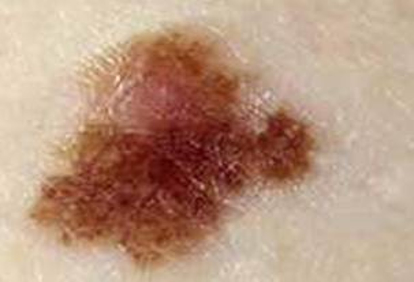 <p>atypical moles that can develop into skin cancer</p><p>lots of small dots (on back)</p>