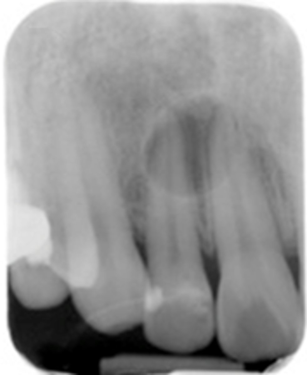 <p>which of these reasons prove that this cysts is NOT associated with the roots of teeth?</p><p>Periapical radiolucent lesion</p><p>Well defined</p><p>Corticated</p><p>Hydraulic/round</p><p>lamina dura</p>