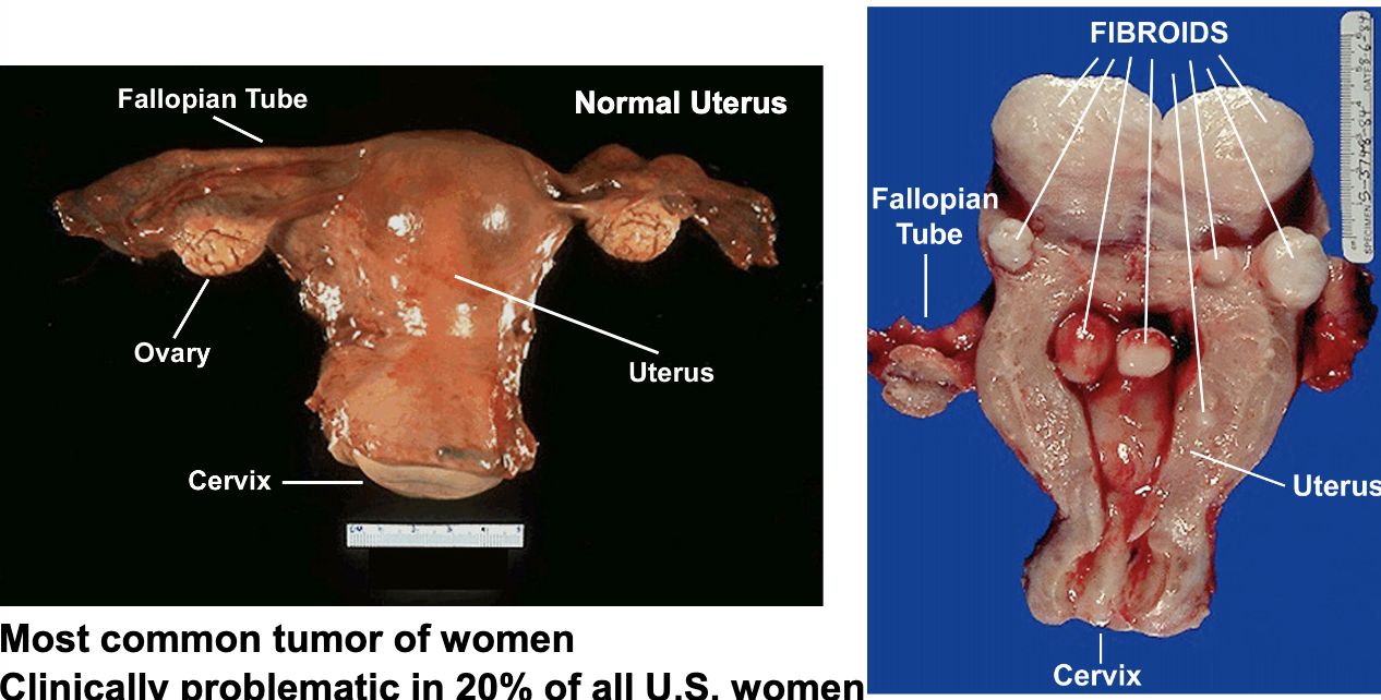 <p>uterine fibroids are a ________ neoplasia of smooth muscle cells. most common tumor of women (affects black women disproportionately)</p>