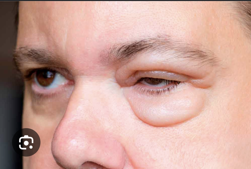 <ul><li><p>Eritrocitos dismórficos&nbsp;</p></li><li><p>Cilindros hemáticos</p></li><li><p>Proteinuria leve &lt;1gr/día</p></li><li><p>Edema periorbitario</p><ul><li><p>Hipertensión leve-moderadaede</p></li></ul></li></ul><p></p>