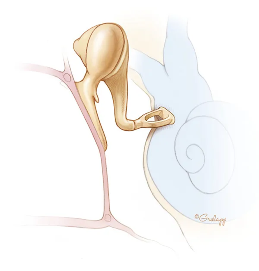 <ul><li><p>malleus —&gt; incus —&gt; stapes —&gt; oval window displacement —&gt; <strong>pressure wave in the fluid within the inner ear</strong></p></li></ul><p></p>