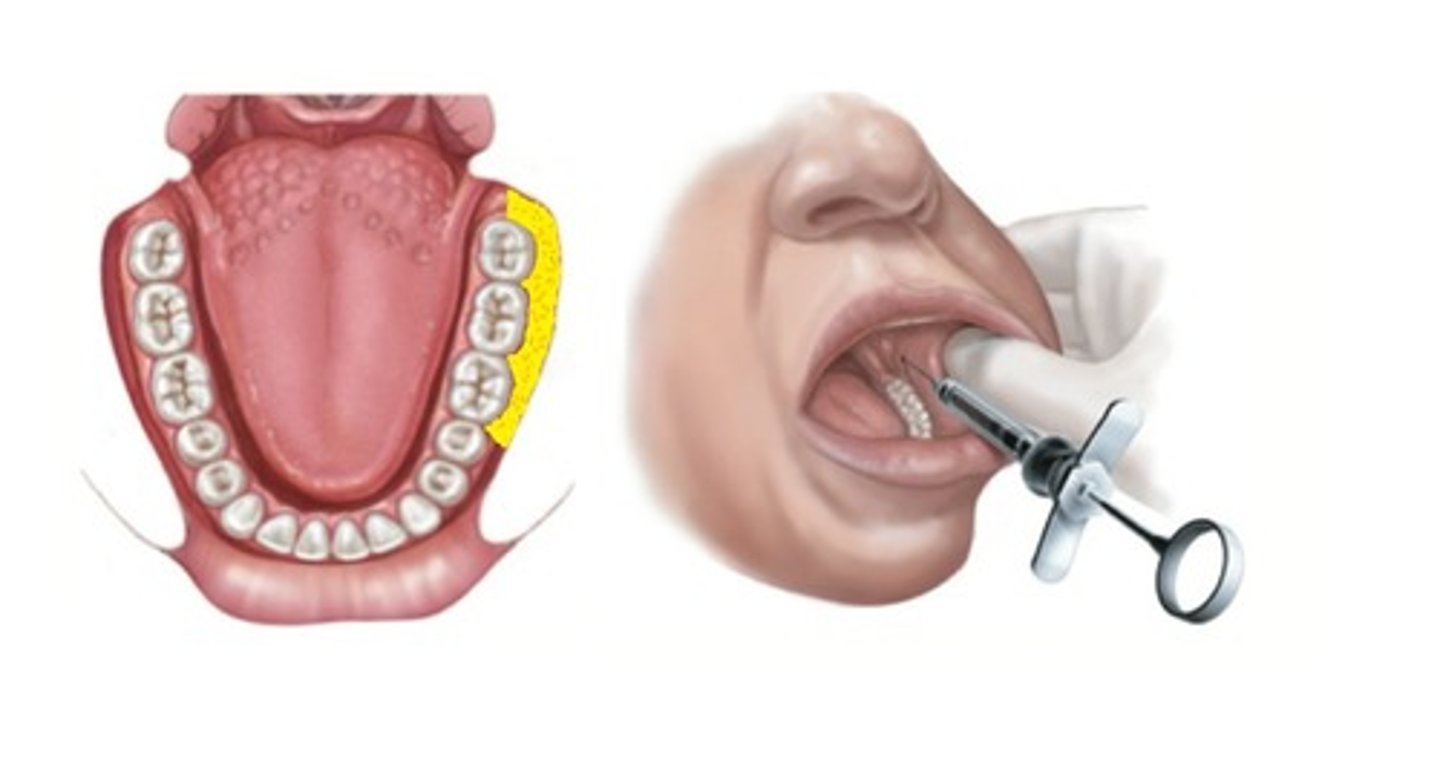<p>Mandibular Molars buccal</p>