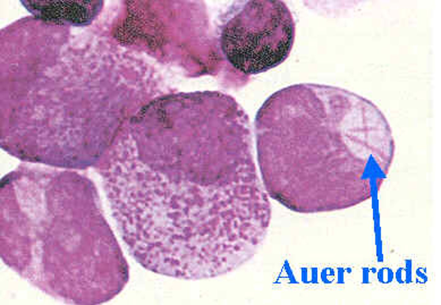 <p>AML</p><p>* median diagnostic age 67 years old</p>