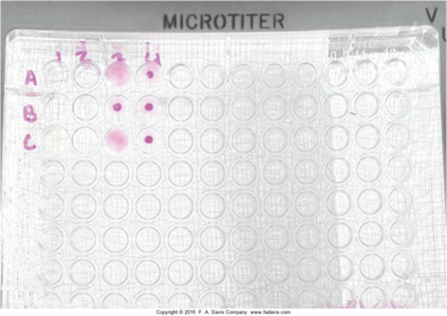 <p>Treponemal test that uses a colored gelatin particles coated with treponemal antigens. </p><p>Note: It is more sensitive in detecting primary syphilis</p>