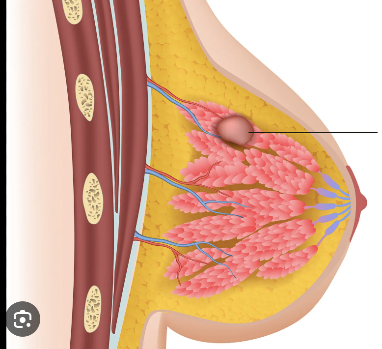 <p>A <strong>benign (non-cancerous) breast tumor</strong> composed of <strong>fibrous and glandular tissue</strong>, typically <strong>round, firm, mobile, and painless</strong>, most common in <strong>young women</strong></p>