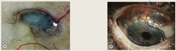 <p>Severe, persistent pain radiating to the temple, brow, or jaw; can interferes with sleep and does not respond to pain medication.</p>