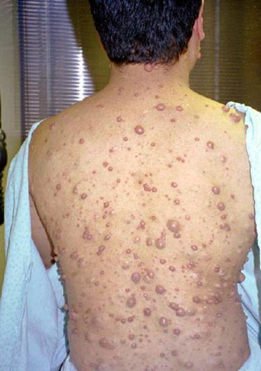 <p>What: An autosomal dominant disorder --&gt; causes by tumor of Schwann cells</p>