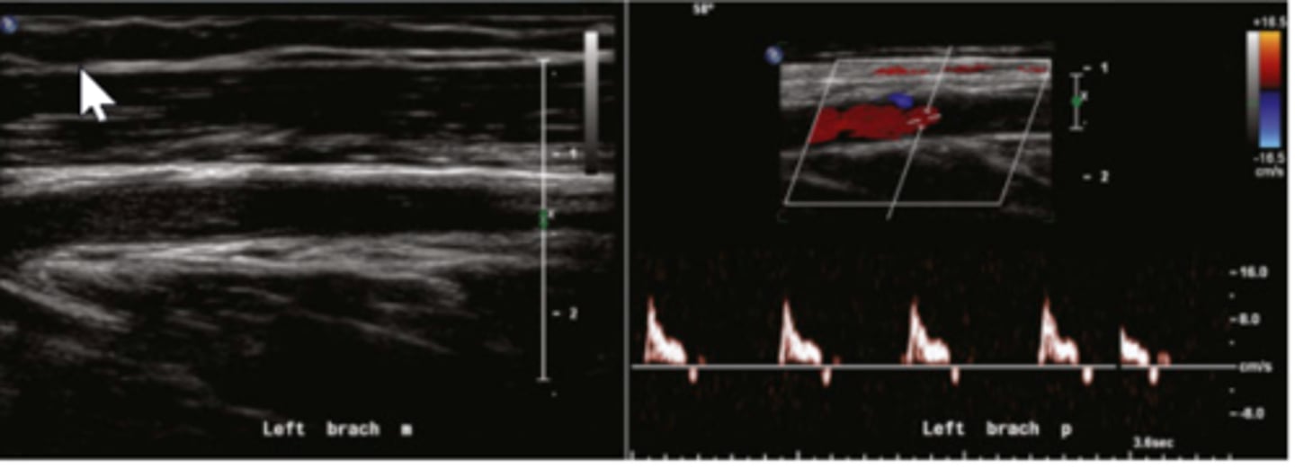 <p>left brachial artery obstruction distal to the spectral Doppler sample site</p>