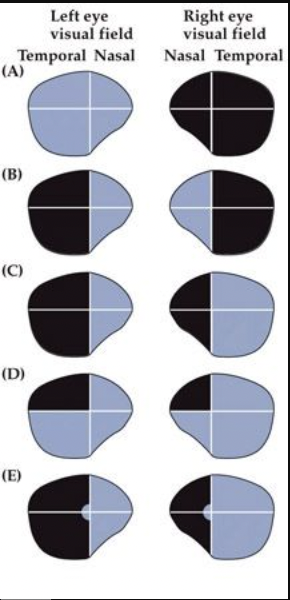 Which of the illustrated visual field deficits would be most likely to result from a lesion of the entire RIGHT optic tract?

 A. (A)
 B. (B)
 C. (C)
 D. (D)
 E. (E)