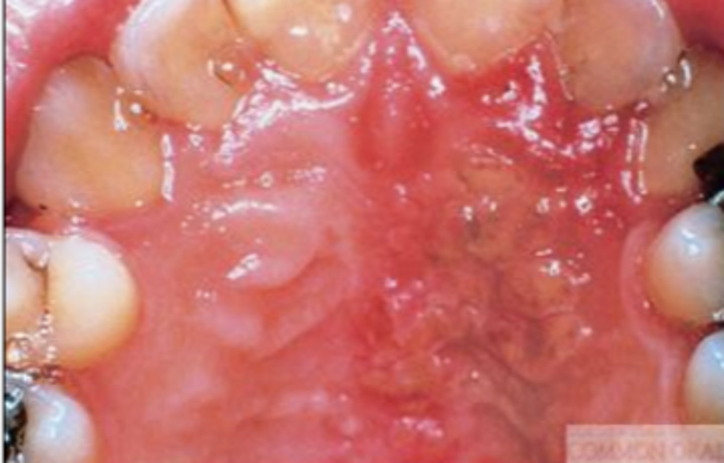 <p>seen in younger populations, under 40!!</p><p>unilateral vesicles and ulcers - intense pain</p>