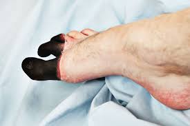 Clear delineation of living / death tissues, Dry gangrene, Autoamputation
