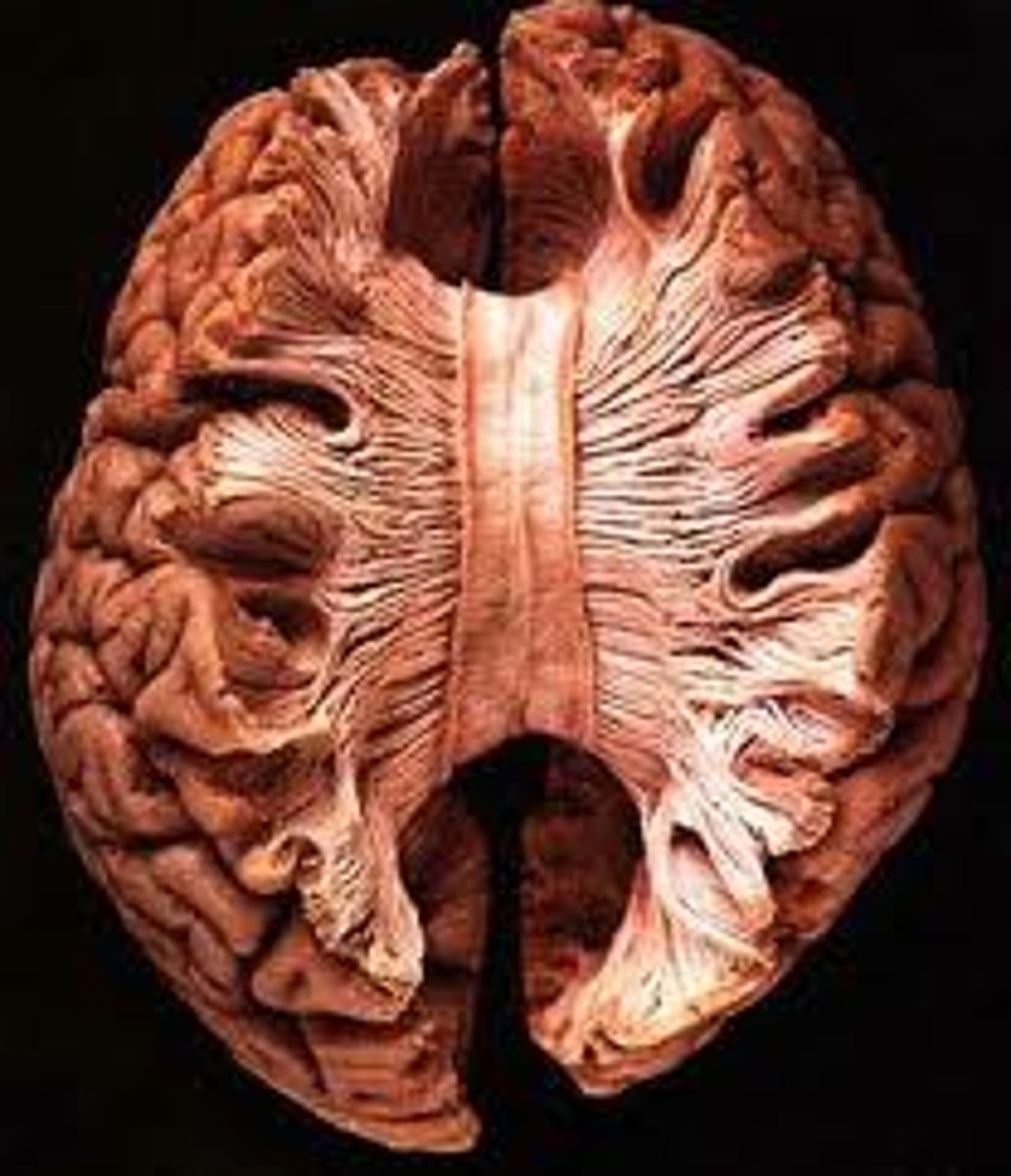 <p>the large band of neural fibers connecting the two brain hemispheres and carrying messages between them, usually cut due to uncontrollable seizures</p>