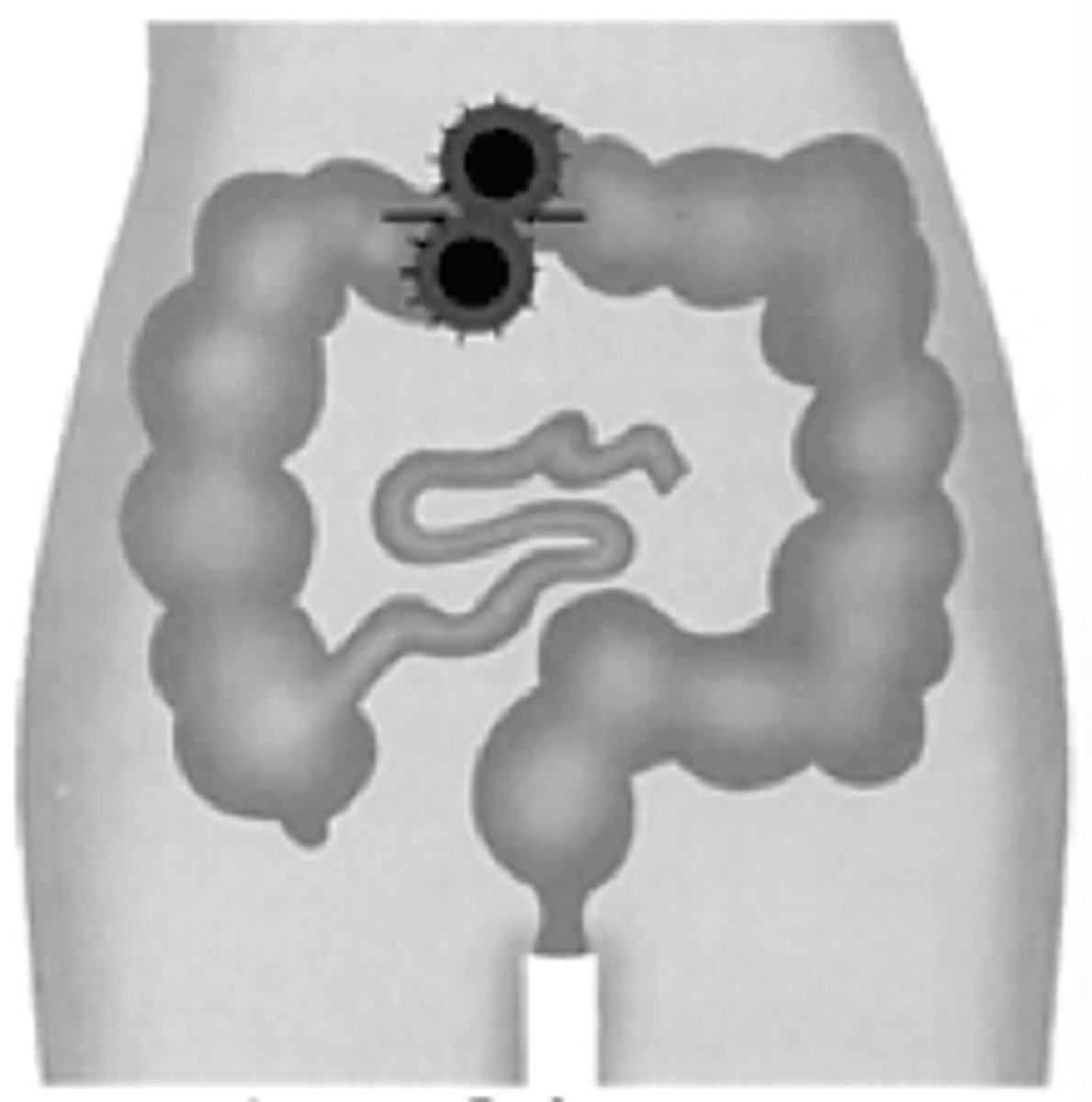 <p>usually LHS</p><p>can be RHS above umbilicus</p><p>one stoma with two holes</p><p>can be reversed easily</p>