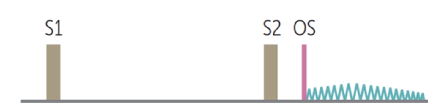 <p>- Diastolic</p><p>- @ Apex</p><p>- mid-diastolic rumble</p><p>- Opening snap</p><p>- low-pitched</p><p>- loud S1</p><p>Louder—squatting</p>