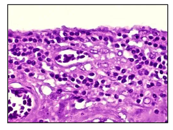 <p>what kind of inflammation is this</p>