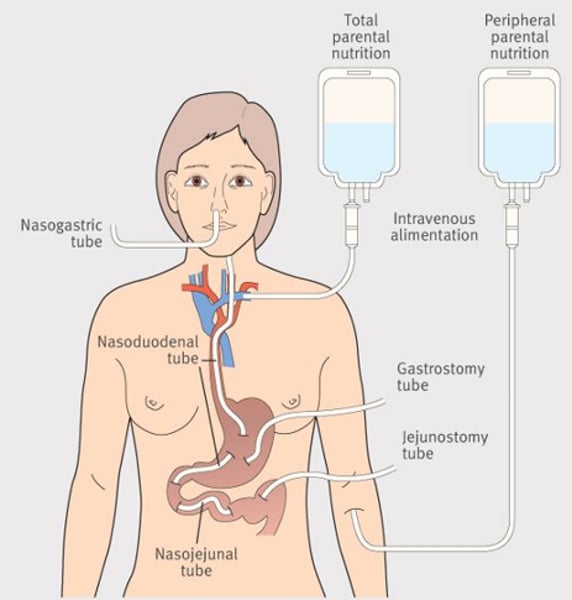 <p>IV (your vein)<br><br>Dietary intake that is administered intravenously (IV)<br><br>-Prevents malnutrition in clients or, if the client is already malnourished, can help correct it. <br><br>- Clients with a digestive system that cannot absorb or tolerate adequate food eaten by mouth can utilize parenteral nutrition.<br><br>- Only administered into a large vein (central vein) <br><br>- For clients without a functioning GI tract, total parenteral nutrition may be the only option.</p>
