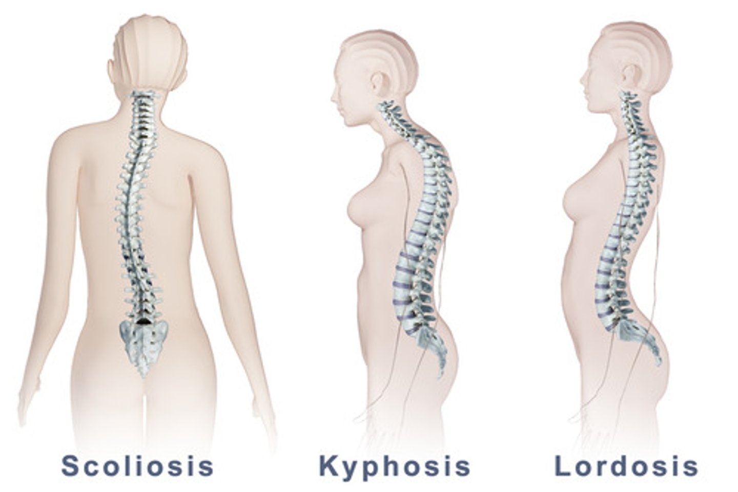 <p>LUMBAR</p><p>Lordosis</p><p>•Excessive is >40 degrees</p><p>•Anterior Pelvic Tilt</p><p>•Overactive hip flexors and low back extensors</p><p>•Weak abdominals, glutes, hamstrings</p><p>•Increased difficulty in diaphragm inhalation</p><p>THORACIC</p><p>Flat Back</p><p>•Hyperactivity in erector spinae and scapular protractors</p><p>•Weakness in scapular retractors and posterior rotator cuff</p><p>Kyphosis</p><p>•Excessive rounding of thoracic area</p><p>•Shortened pectoralis and intercostals</p><p>•Lengthened erector spinae, rhomboids, and trapezius</p><p>•Protracted scapulas</p><p>•Can lead to Thoracic Outlet Syndrome</p><p>Scoliosis</p><p>•Lateral or Rotational curve of the spine</p><p>•Cause muscle fatigue and increased ligament stress and impingement of the nerve roots</p><p>•May be corrected</p><p>CERVICAL</p><p>Forward Head Posture</p><p>•Upper Crossed Syndrome</p><p>•May increase</p><p>⚬Irritation to cervical disk</p><p>⚬Nerve root pressure</p><p>⚬Risk of impingement</p><p>•Can lead to</p><p>⚬Dowager’s Hump</p><p>⚬Temporomandibular joint disorders</p>