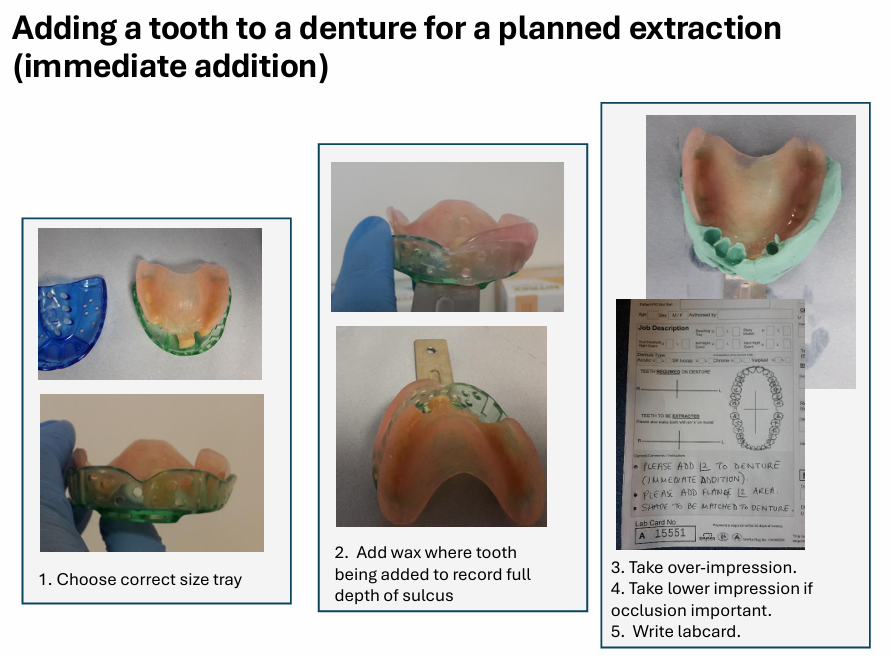 <ol><li><p>choose the correct size tray </p></li><li><p>add <strong>wax</strong> where tooth being added to record full depth of sulcus </p></li><li><p>take over-impression</p></li><li><p>take lower-impression if occlusion important </p></li><li><p>write lab card</p></li></ol><p>the tooth to be extracted will be removed from the cast and an artificial tooth added to the&nbsp;</p><p></p>