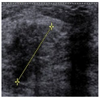 <p>What does this Ultrasound image show?</p>