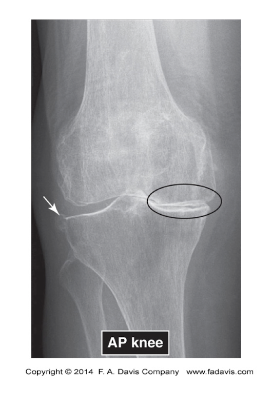 <p>Knee OA Pic </p>