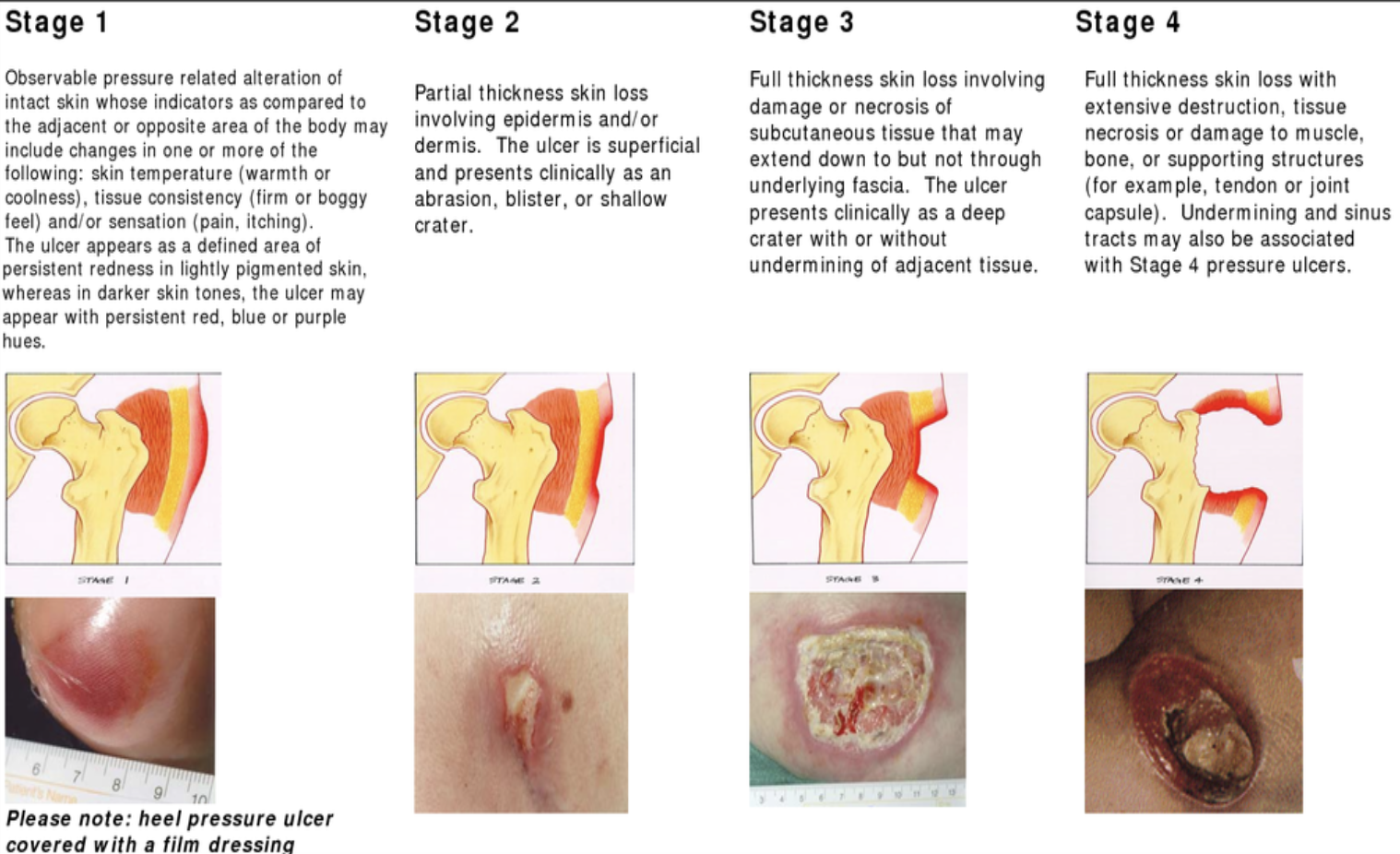 <ol><li><p>red skin and tingling</p></li><li><p>blister</p></li><li><p>skin peels</p></li><li><p>damages tendons or bones </p></li></ol><p></p>