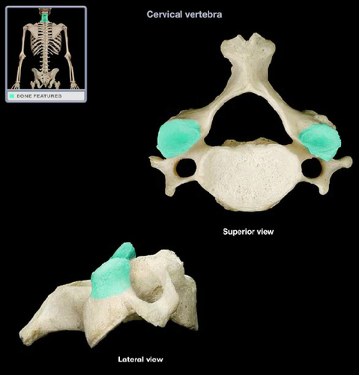 <p>In CERVICAL SPINE, the superior facet of lower segment faces ______________, ______________, and slightly ___________.</p>