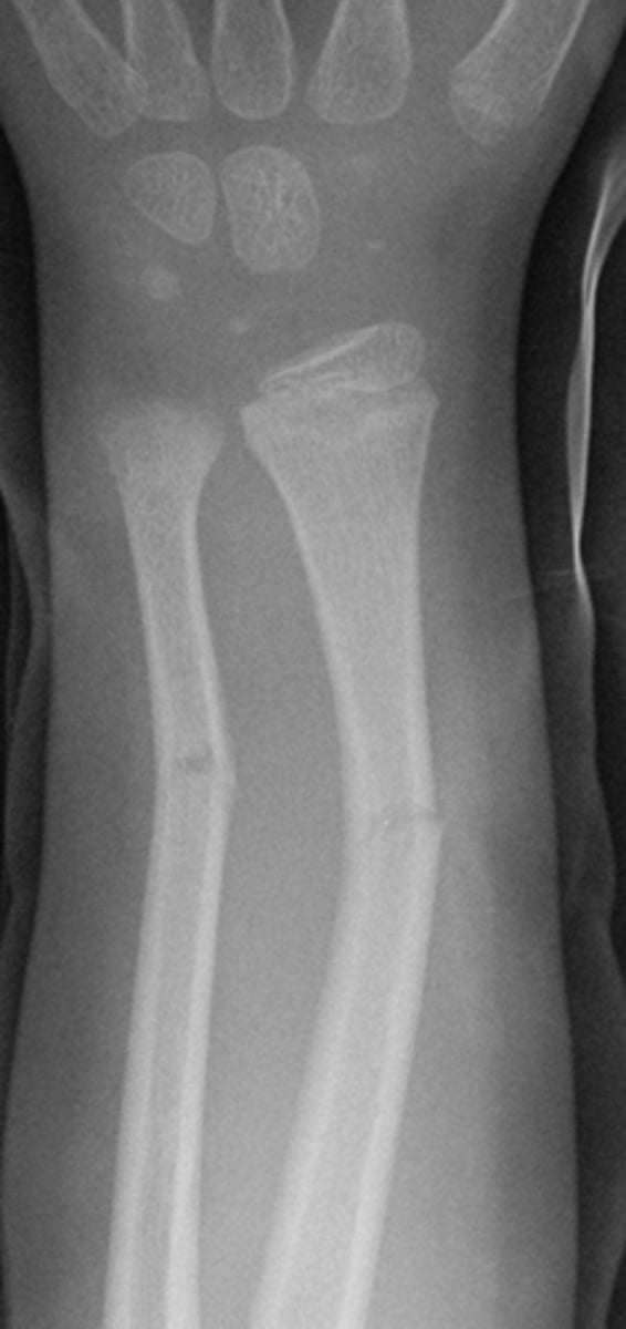 <p>What type of fracture is this?</p>