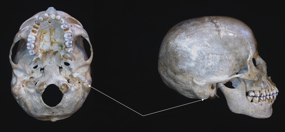 mastoid process 