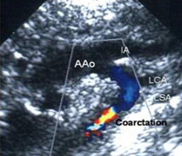 <p><strong>dilatation</strong> of aortic sinuses and ascending aorta</p><p><strong>coarctation&nbsp;of aorta</strong></p><p>aneurysm </p><p>aortic dissection </p>