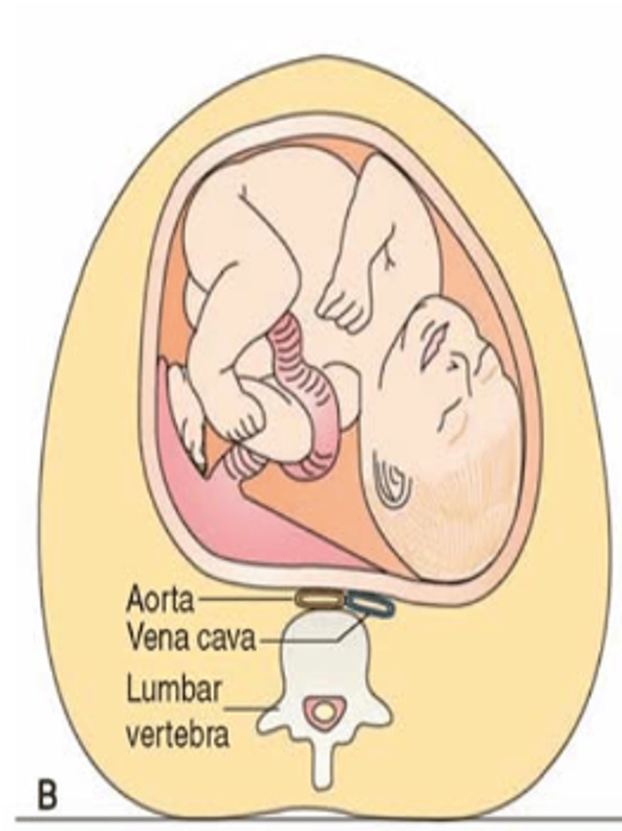 <p>Compresses both when patient is supine.</p><p>IVC compression: Reduces venous return to heart (drop in preload and CO). Can be severe and lead to loss of consciousness.</p><p>Aortic compression: Reduced uteroplacental and renal blood flow. </p>
