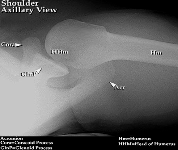 <p>glenoid and humeral head for fractures and dislocations </p>