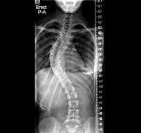 <p><strong>lateral </strong>curvature of the vertebral column</p>