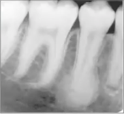 <p>well defined dense bone associated with <strong>VITAL</strong> tooth and is often <strong>asymptomatic</strong></p>