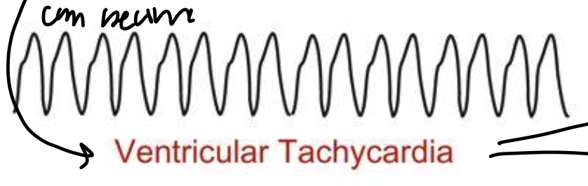 <ul><li><p>ventricular coupling is not driven from atrial coupling</p></li><li><p>no P/T waves are visible because ventricular rate is so high</p></li></ul><p></p>
