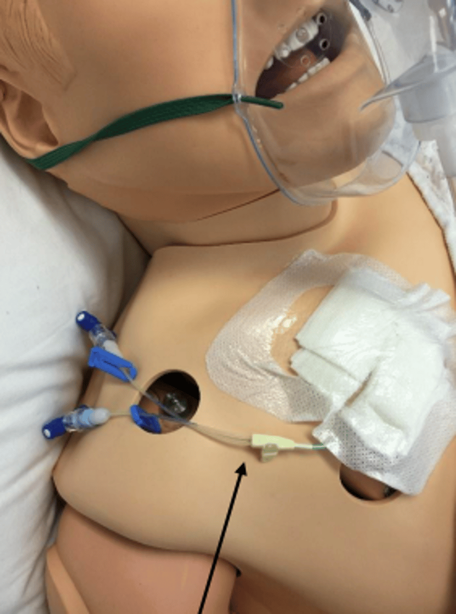 <p>plastic IV tube used to measure pressure in right atrium or superior vena cava</p><p>- gives most accurate blood pressure</p><p>- surgically inserted</p>
