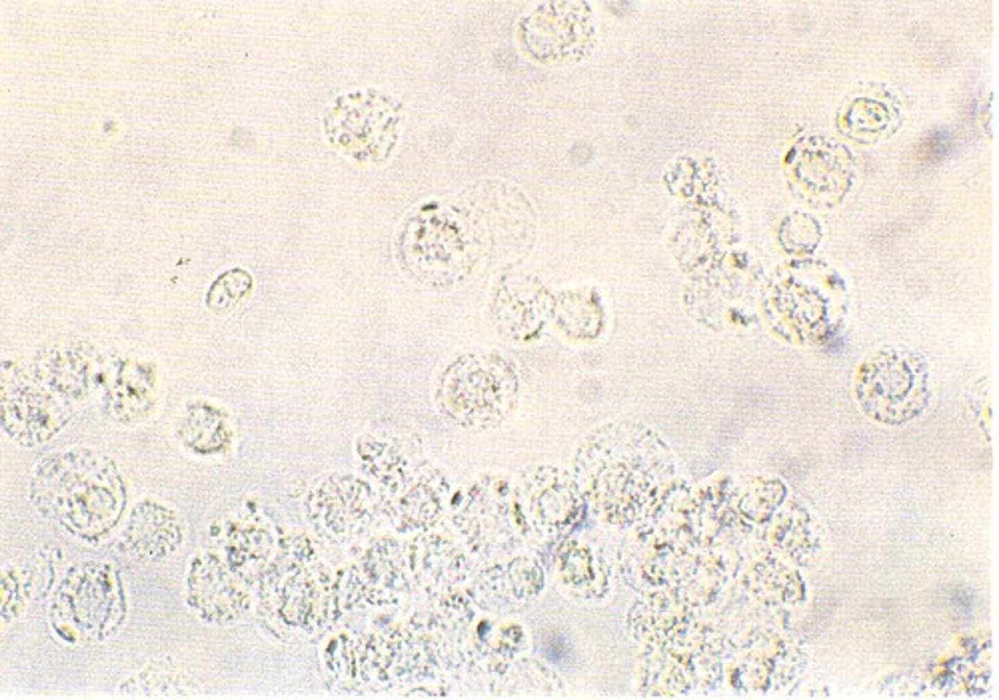 <p>Appear as either neutrophils, eosinophils or mononuclear cells</p><p>- Neutrophils: contain granules and multi-lobed nuclei. If Brownian movement is observed due to swelled cells, then the granules appear to sparkle "glitter cells"</p><p>- Eosinophils: Is primarily associated with drug-induced interstitial nephritis. Small numbers may also be seen in UTIs and renal transplant rejection.</p><p>Since they are not normally seen, the finding of more than 1% Eos is considered clinically significant</p><p>- Mononuclear Cells: Lymphs, Monos, Macrophages. Lymphs are very small and can be confused with RBCs, Monos and Macrophages are usually large cells that may appear vacuolated or contain inclusions. They need to be differentiated from RTE cells, which are usually larger, with a eccentrically located nucleus</p>