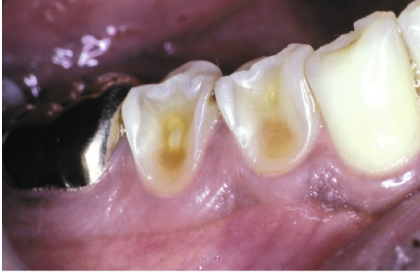 <ul><li><p>Loss of entire buccal cusps</p></li><li><p>Replacement by<strong> ski slope-like</strong> <strong>depressions</strong> from lingual cusp to buccal cementoenamel junction</p></li></ul><p></p>