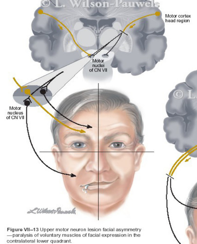 -Paralysis or paresis (weakness) present in group of muscles 

-Often stereotypic postures and movement patterns in the UE and LE 

-Classic description: Spastic Paralysis 

-Spasticity/Increased DTRs/Abnormal Cutaneous (sensory) reflexes 

-Abnormal timing of muscle activation so can't isolate movements 

-May see slight disuse muscle atrophy