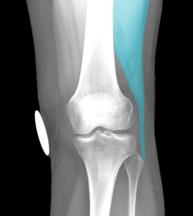 Action:
Extension of thigh (long head)
Flexion of leg