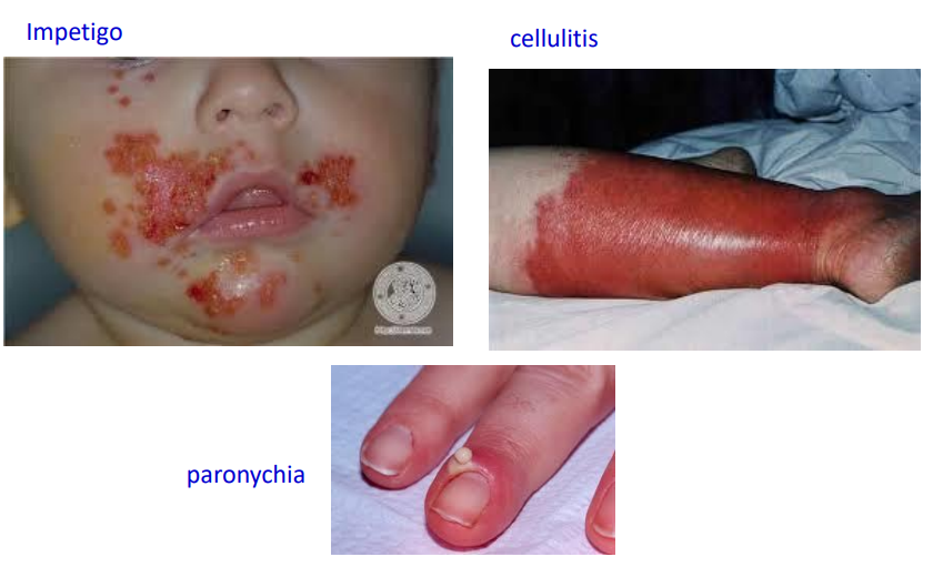 <ol><li><p>Impetigo </p></li><li><p>cellulitis </p></li><li><p>paronychia</p></li></ol><p></p>