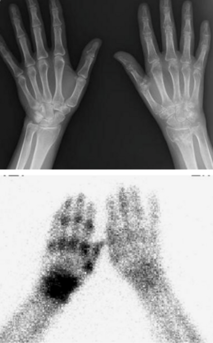 <p>Bone scan showing diffuse increased uptake in affected extremity or x-ray showing generalized osteopenia</p>