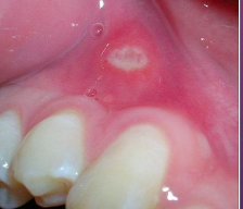 <p>What is the cause of an aphthous ulcer?</p>