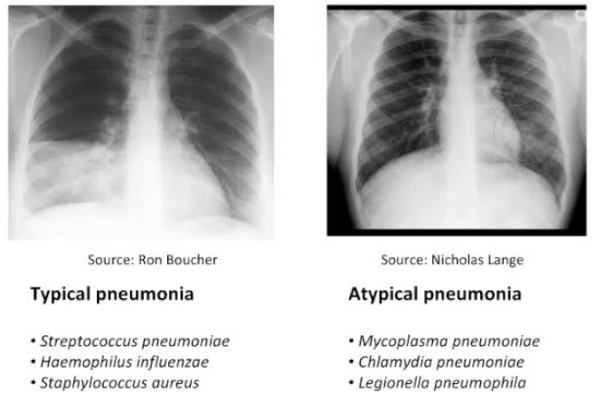 <p>X-ray</p><ul><li><p>Pulmonary infiltrate (opacity) → Air bronchogram (darker air-filled bronchioles on top)</p></li><li><p>Typical: Opacity in 1 lobe</p></li><li><p>Atypical: Reticular (radiating) opacity</p></li></ul><p>Severe: Identify pathogen + evaluate treatment</p><ul><li><p>CBC</p></li><li><p>Sputum gram stain + culture</p></li><li><p>Urinary antigen test</p></li></ul><p></p>