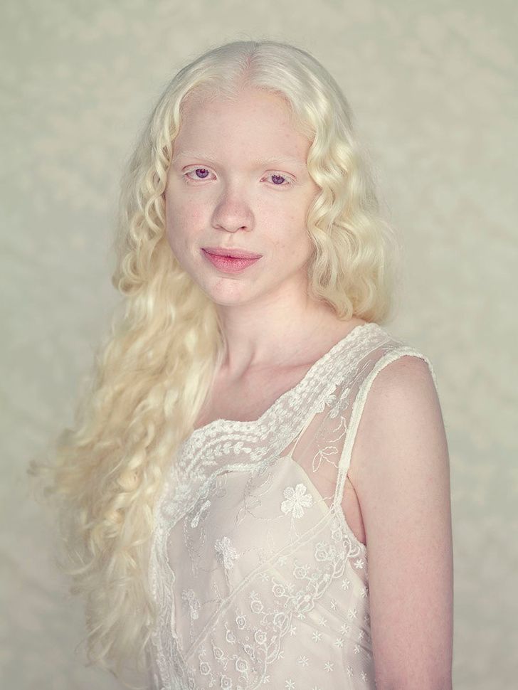 <p>Albinism is a condition characterized by the <strong>absence of pigment in skin, hair, and eyes. </strong></p><ul><li><p><u>Physical trait</u>s: pinkish skin and pale hair (blonde or white) </p></li><li><p>Sensitivity to light (due to lack of pigment in eyes) </p></li></ul><p></p>